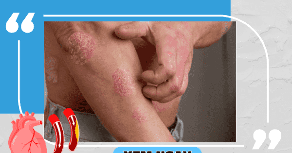 Làm gì để ngăn ngừa biến chứng của vảy nến và giải pháp từ Kim Miễn Khang?